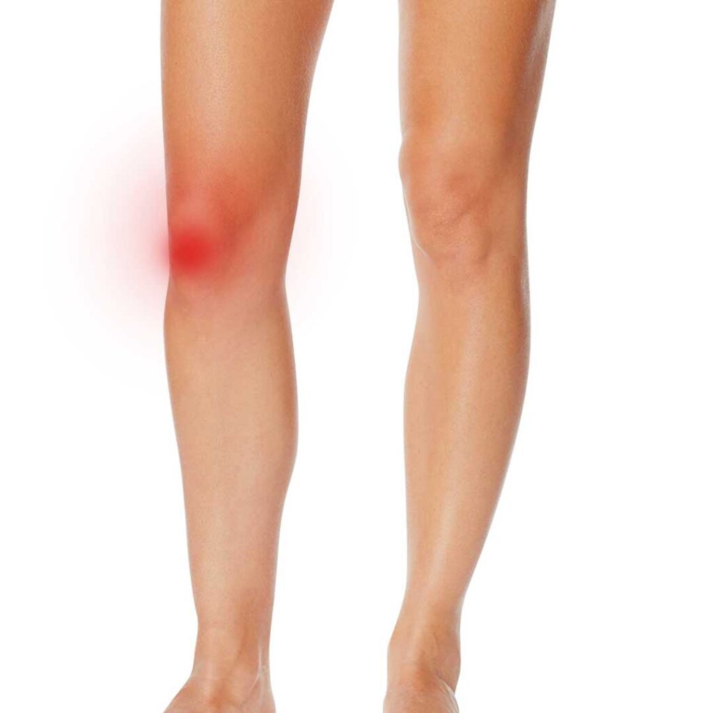 Patellofemoral Knee Pain