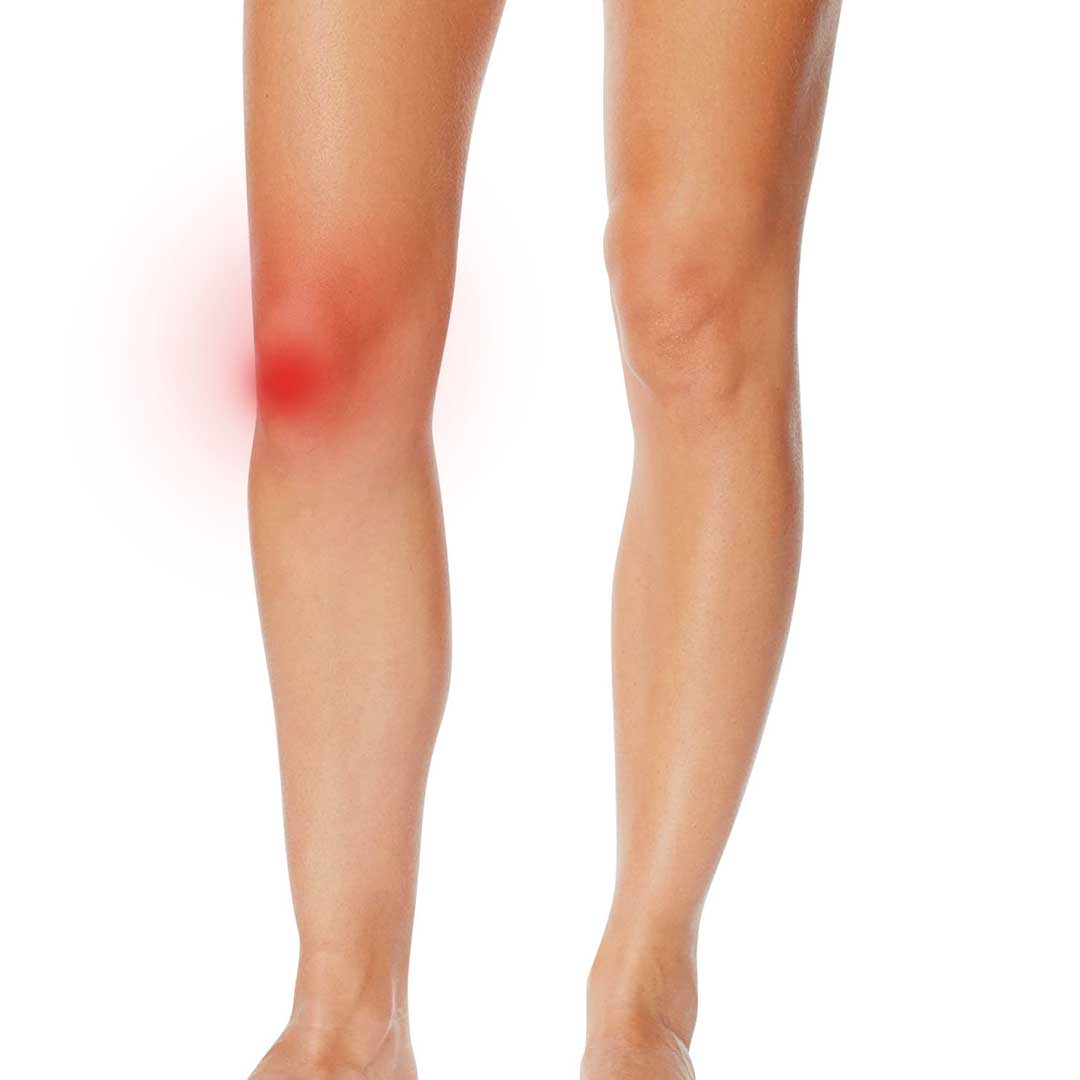 Patellofemoral Knee Pain